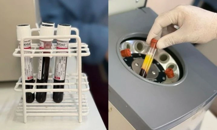 Proceso del tratamiento PRP paso a paso

