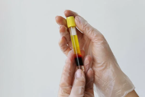 Muestra del tratamiento de Plasma Rico en Plaquetas 

